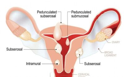 Uterine Fibroids
